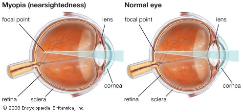 Myopia (Nearsightedness) in Children & Teens: What Parents Need To Know - Heavyglare Eyewear Myopia (Nearsightedness) in Children & Teens: What Parents Need To Know - Heavyglare Eyewear