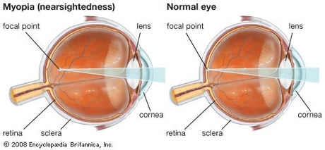 Myopia (Nearsightedness) in Children & Teens: What Parents Need To Know - Heavyglare Eyewear